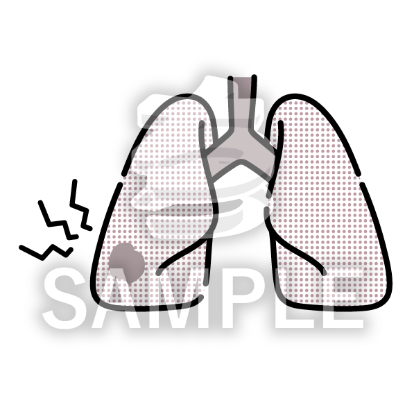 肺がんのイラスト